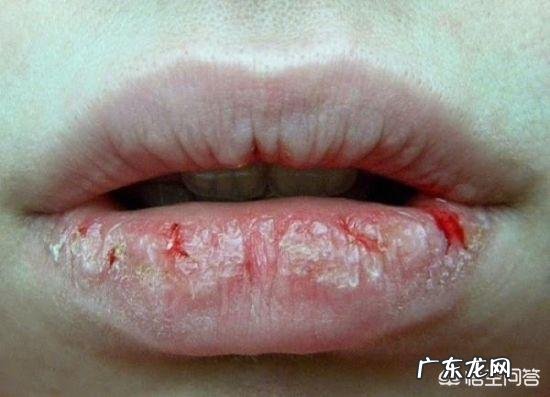 嘴唇干裂脱皮是什么原因引起的?