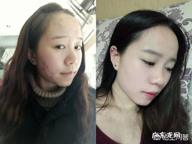 嘴角起痘痘怎么回事?