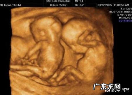 为什么双胎不用做唐氏筛查和四维彩超?医生说没有意思?