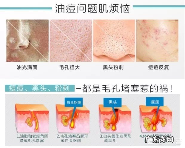 你觉得青少年用什么药膏擦痘痘好？为什么？