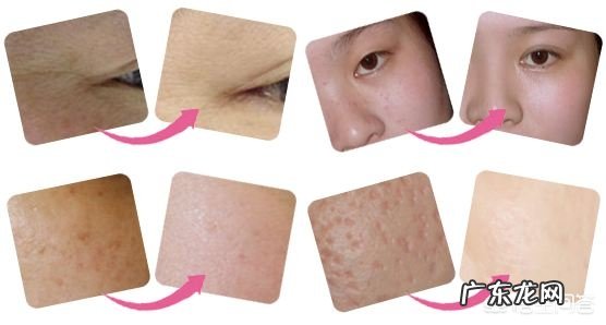 光子嫩肤会反弹吗?