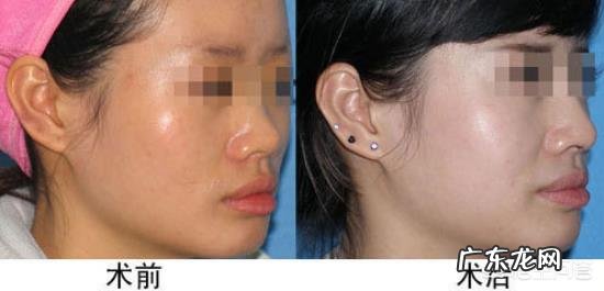 光子嫩肤会反弹吗?