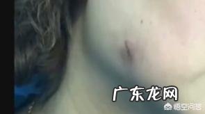 瘦脸针有什么副作用吗?