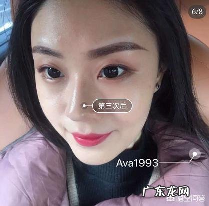 瘦脸针有什么副作用吗?