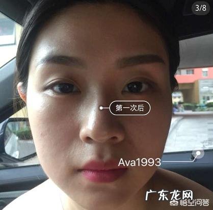 瘦脸针有什么副作用吗?