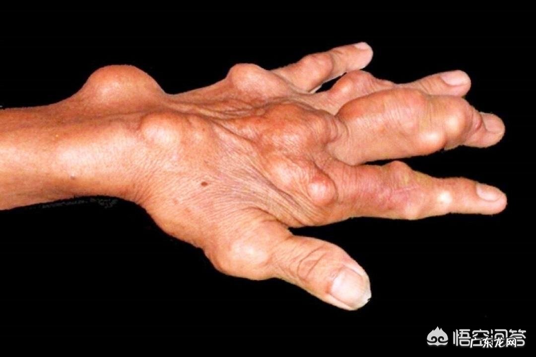 农村什么植物对降尿酸有效果?