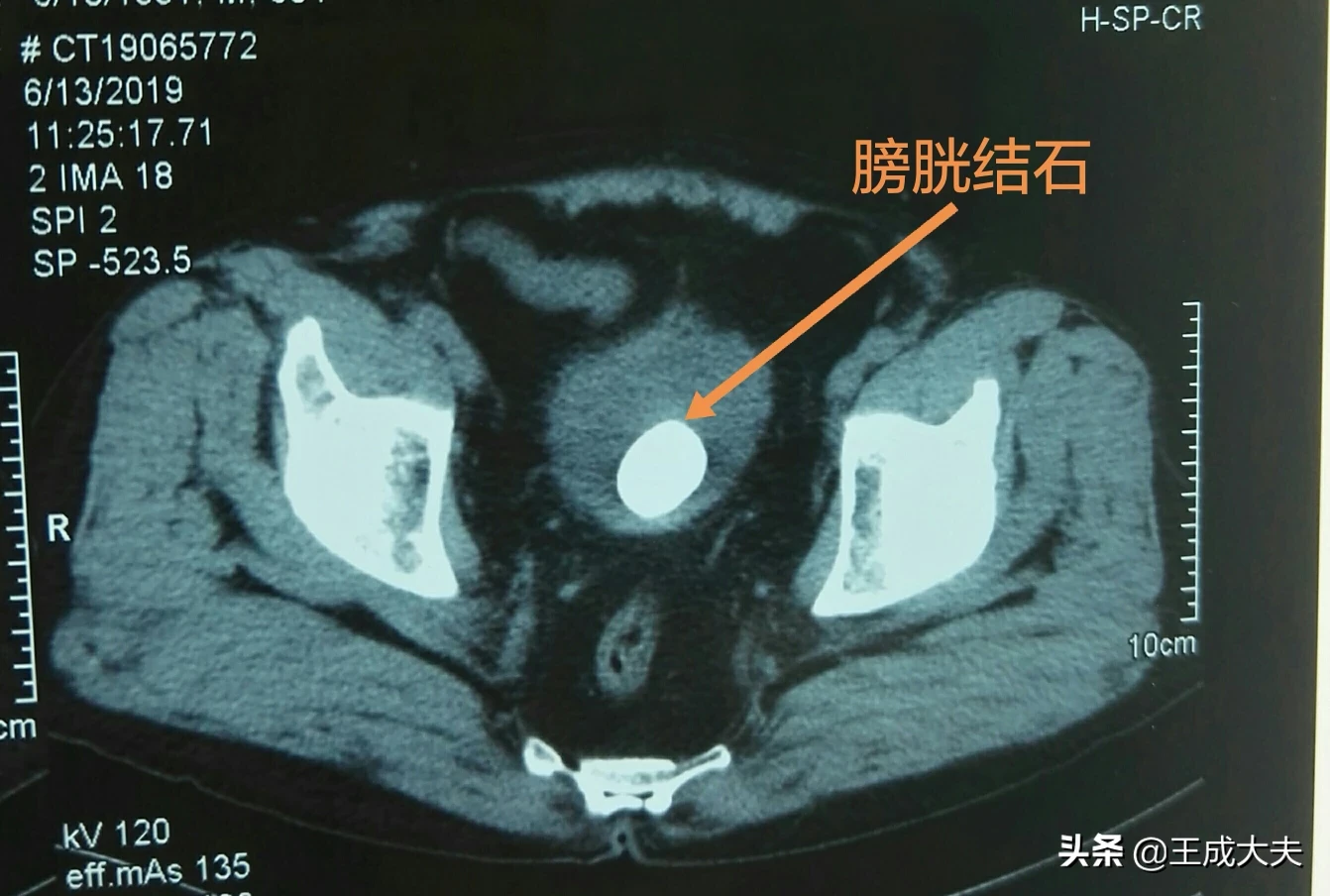 一病人尿不能自控,需道尿管道尿。如道尿管永久放里面不取不出来,对身体会有什么害处?