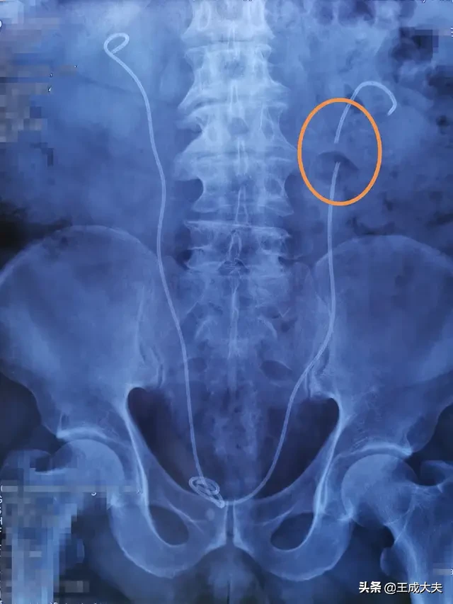 一病人尿不能自控,需道尿管道尿。如道尿管永久放里面不取不出来,对身体会有什么害处?