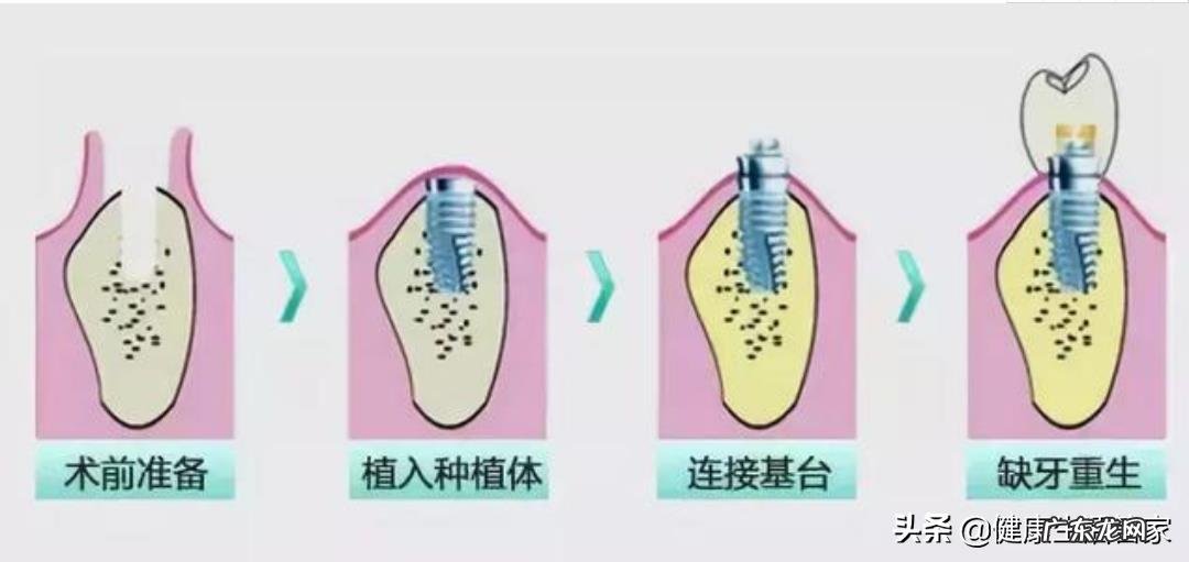 一颗一万五的种植牙和一颗六千的种植牙,到底差别在哪?
