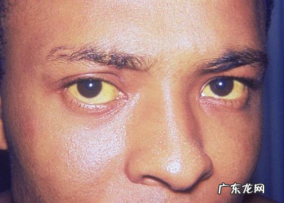 4种食物最伤肝,生活中要少吃,记住“养肝四点”,肝好更健康,指的是什么?