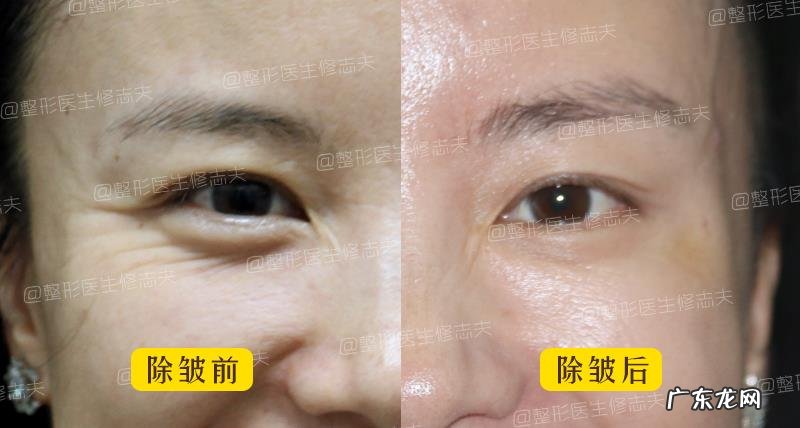 从小笑起来眼角就有皱纹,还很严重,怎么办?