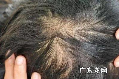 用生姜擦头皮长头发吗 脱发擦生姜能长出头发吗有效果吗