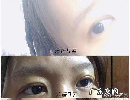 割双眼皮到底好不好?