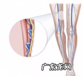 静脉血管肿胀的原因 静脉血管瘤严重吗