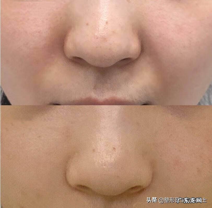 法令纹出来了还能消除吗 法令纹怎么消除法令纹