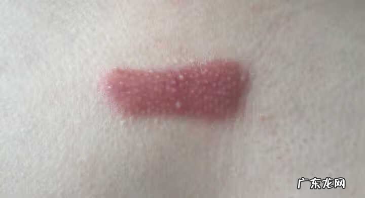 胸口有疤痕的人命运 胸口有疤痕有风水影响吗