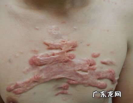 胸口有疤痕的人命运 胸口有疤痕有风水影响吗