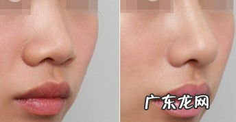 膨体材料隆鼻要多少钱 做隆鼻膨体要多少钱一次