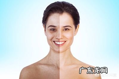 哪些人最容易长黄褐斑？该怎么预防？