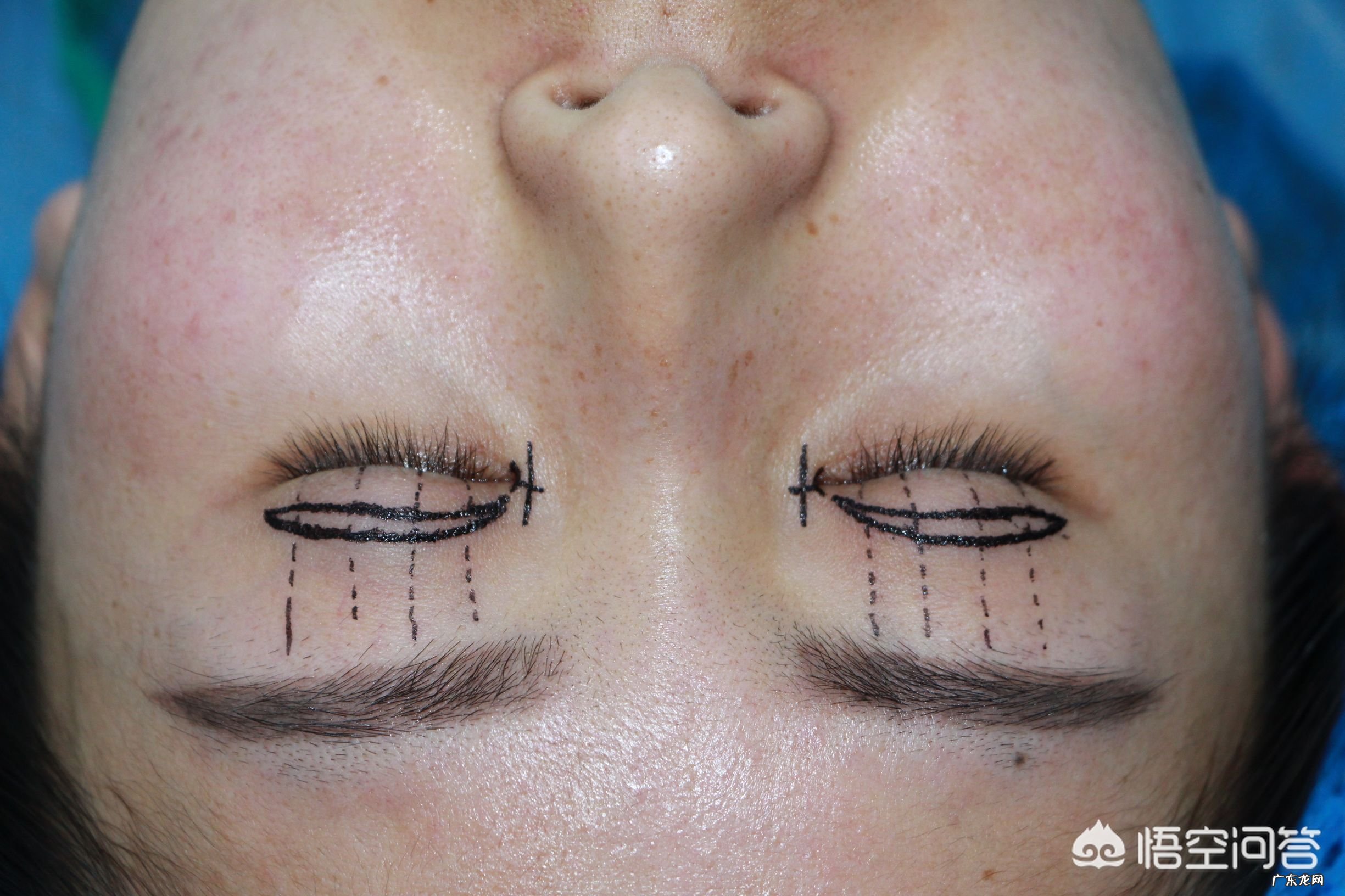 上眼窝凹陷怎么修复?