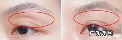 上眼窝凹陷怎么修复?