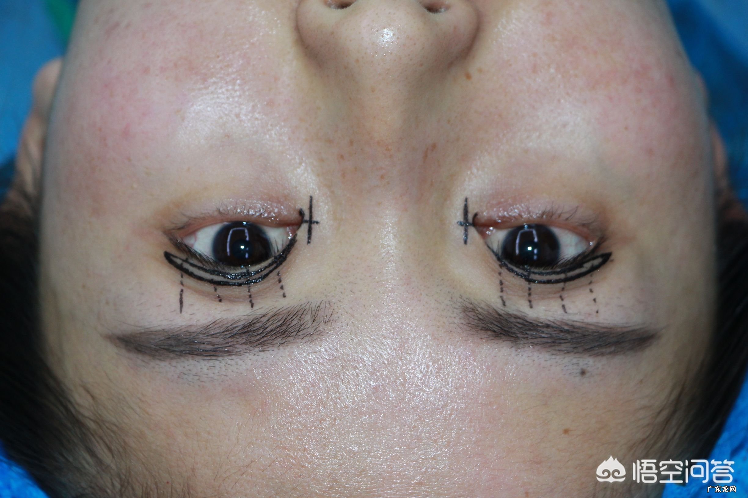 上眼窝凹陷怎么修复?