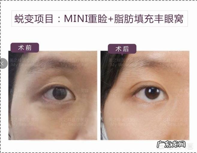 上眼窝凹陷怎么修复?