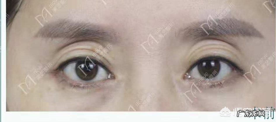 上眼窝凹陷怎么修复?