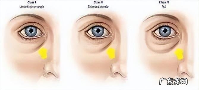 泪沟不难搞，选对方法就是“克星”