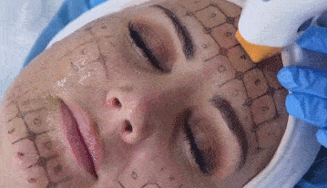 针对不同的脸型，热玛吉的抗衰设计方案是怎样的？