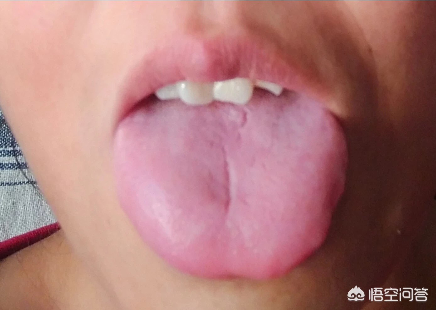 严重口臭吃点什么药能治疗?