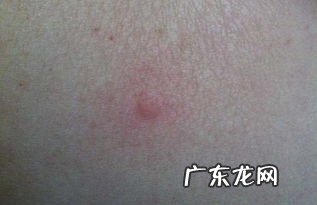 被跳蚤咬多久才好 床上跳蚤咬的症状图片