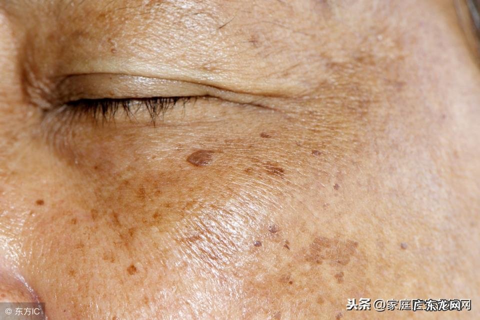 身上长了老年斑怎么办 手上长了老年斑怎么回事