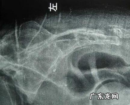 尾骨骨折能蹲着大便吗 尾骨骨折蹲便还是坐便