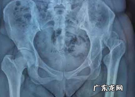 尾骨骨折能蹲着大便吗 尾骨骨折蹲便还是坐便