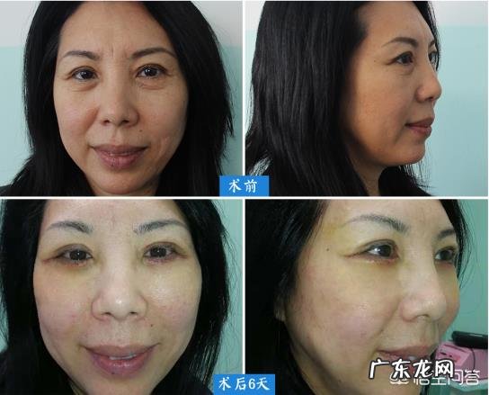 什么样的方法能够比较好的去除眼袋和鱼尾纹?