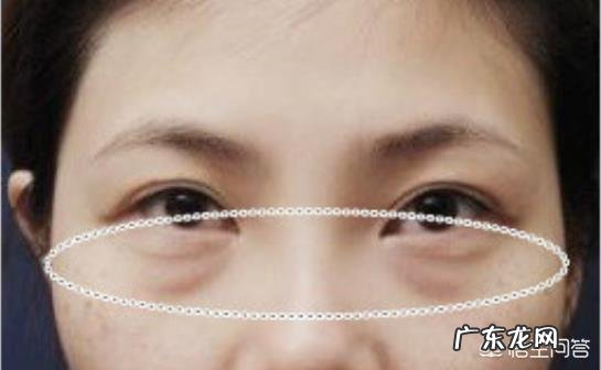 什么样的方法能够比较好的去除眼袋和鱼尾纹?