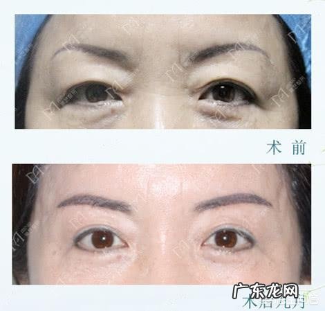 什么样的方法能够比较好的去除眼袋和鱼尾纹?