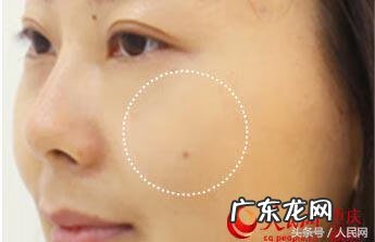 激光祛斑 quban8.org 激光祛斑斑