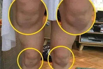 脸上挂着笑容 膝盖有笑脸怎么办