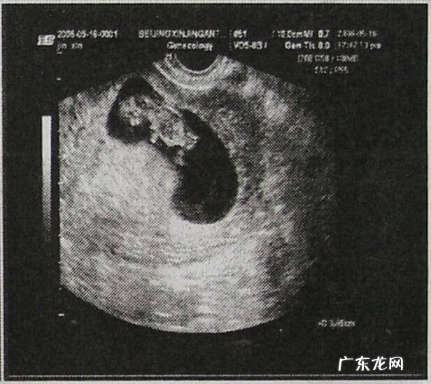 长孕囊和圆孕囊的区别 孕囊是什么