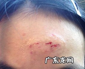 微创手术伤口结痂多久脱落 伤口结痂了可以洗澡吗