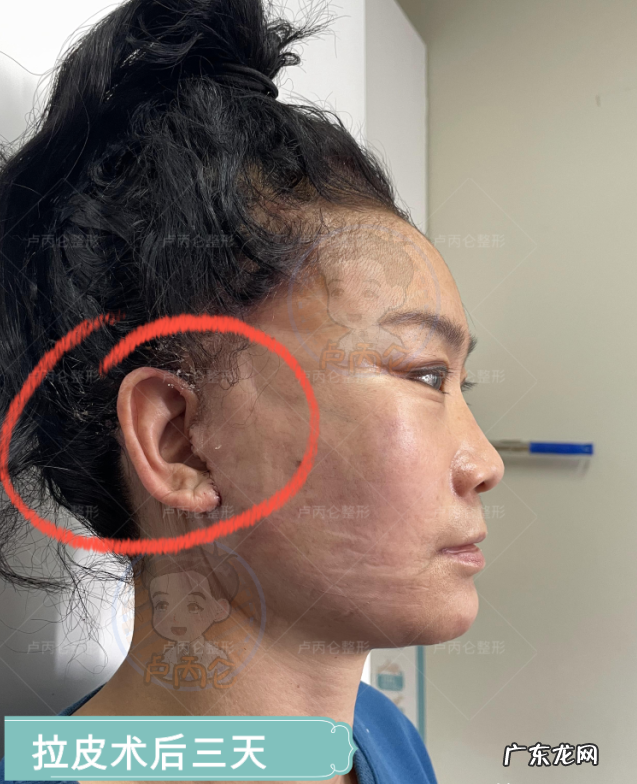 拉皮除皱手术有哪些风险和后遗症?