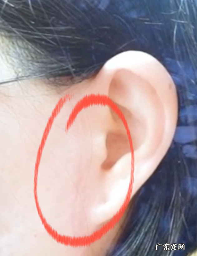 拉皮除皱手术有哪些风险和后遗症?