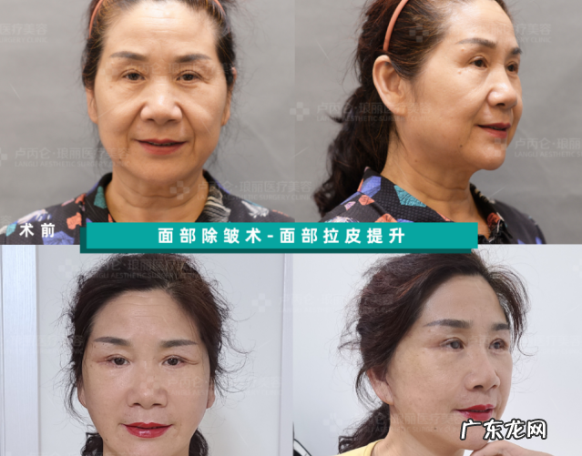 拉皮除皱手术有哪些风险和后遗症？