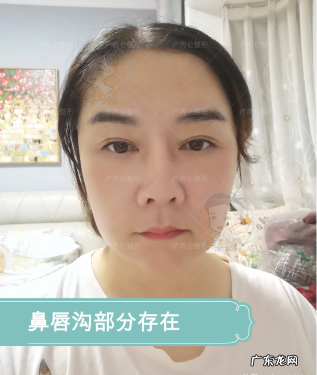 拉皮除皱手术有哪些风险和后遗症?