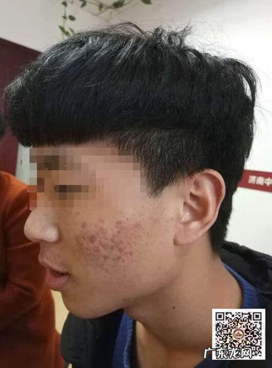 青春痘用什么方法才可以治好 怎么治青春痘好?