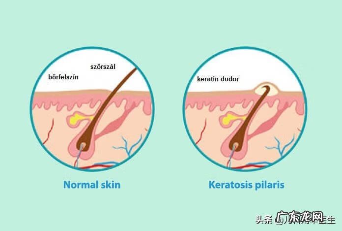 如何去除鸡皮肤小窍门 鸡皮疙瘩皮肤病