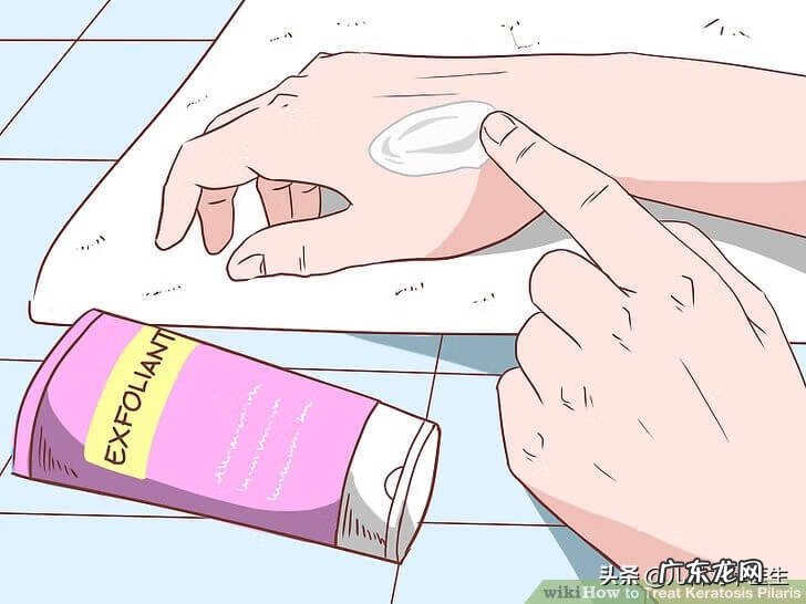 如何去除鸡皮肤小窍门 鸡皮疙瘩皮肤病