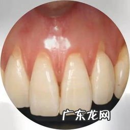 梦见牙齿腐烂脱落很多血 梦见牙齿腐烂脱落女的解梦是什么